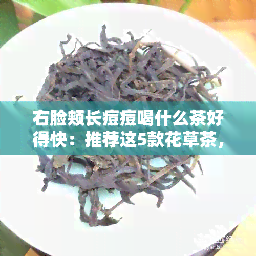 右脸颊长痘痘喝什么茶好得快：推荐这5款花草茶，助你快速消除痘痘！